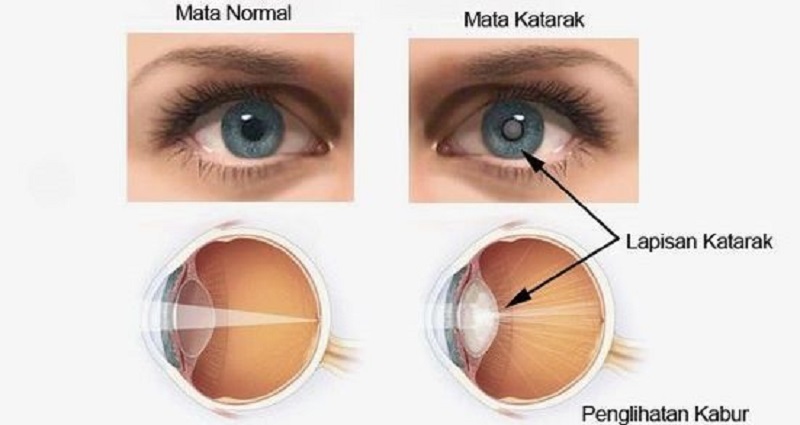 Katarak